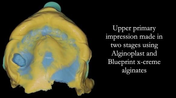 Finlay's Newsletter 58 Gasket upper partial denture for Zoe