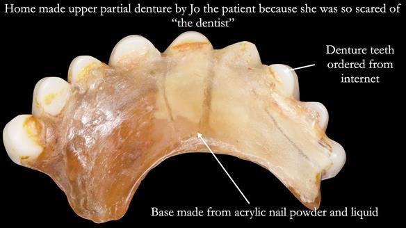 Newsletter 52 Managing Jo’s failing dentition with extractions and Mk 1/Mk 2 complete upper dentures and lower partial dentures FULL PROTOCOL