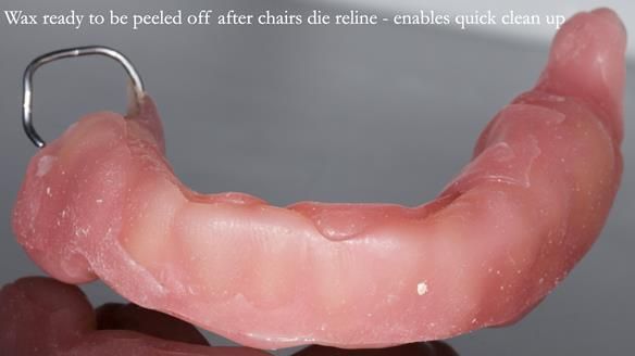 Newsletter 82 Mary - A complete upper and a one-tooth gasket denture