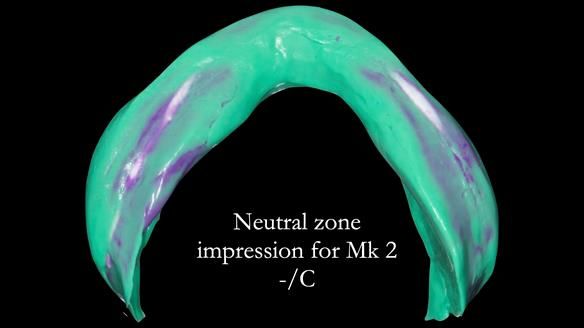 Replacing Madeline’s Complete denture FULL PROTOCOL