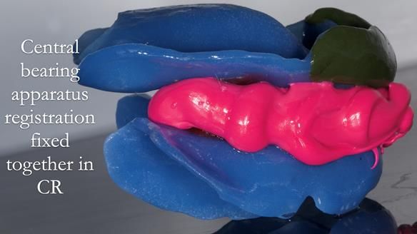 Newsletter 53 showing the making and fitting of ultra life-like dentures for Valena