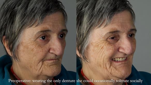 Newsletter 83: Sheila’s Complete Denture Success
