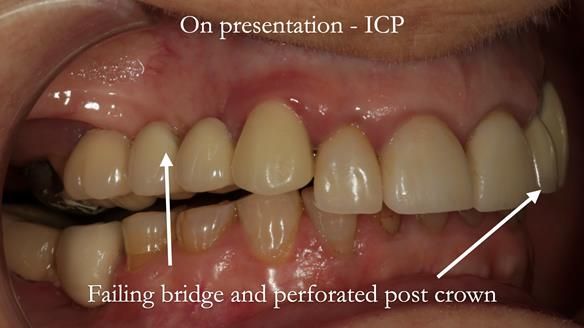 Newsletter 51 Managing Anne’s failing dentition with distal extension base RPD/Splint FULL PROTOCOL
