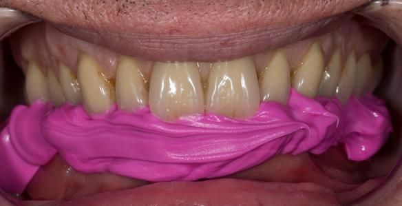 Figure 87 Visit 3 for Mk 2 fabrication. Inter-maxillary record of the maxillary Mk 1 denture. This allowed a copy of the Mk 1 to be mounted on the articulator to allow the Mk 2 denture to mimic the tooth arrangement. The patient was happy with the aesthet