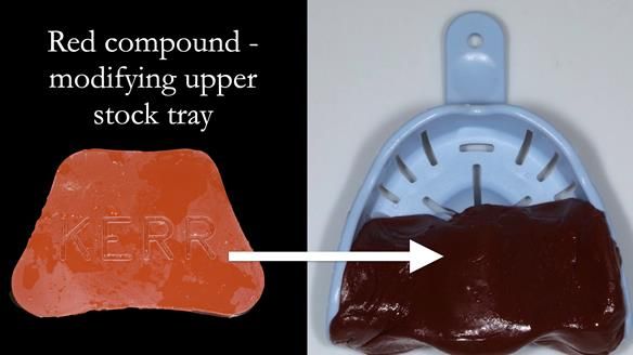 Newsletter 56 showing the making and fitting of a bilateral free end saddle upper removable partial denture (RPD) for patient with pemphigus