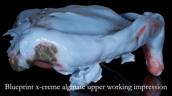 Newsletter 52 Managing Jo’s failing dentition with extractions and Mk 1/Mk 2 complete upper dentures and lower partial dentures FULL PROTOCOL