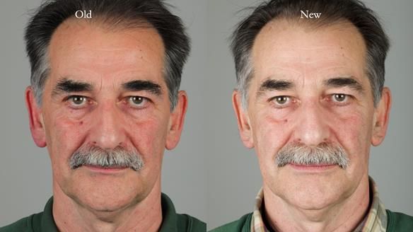 Newsletter 78: What do Clark Gable and a Locator® overdenture have in common?