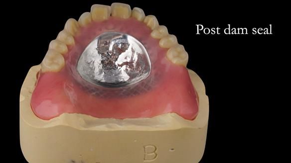 Complete denture Class II div 2 deep overbite Newsletter 39
