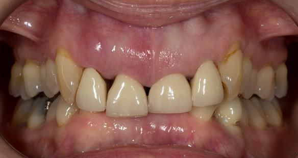  Figure 4 Overeruption of the upper and lower anterior segments with traumatic overbite and aesthetic failure