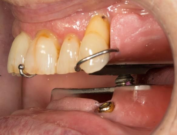 Figure 24 Inter-maxillary registration with central bearing apparatus in the mouth with the maxillary and mandibular parts "locked" together in CR by the pin in the hole