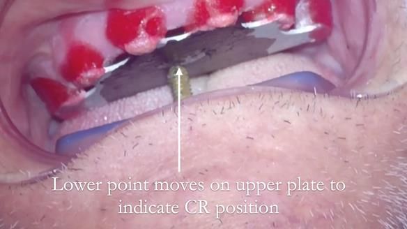 Managing poor implant positioning with complete dentures and Locator attachments - full protocol Newsletter 41