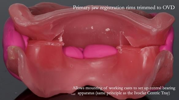 Newsletter 83: Sheila’s Complete Denture Success