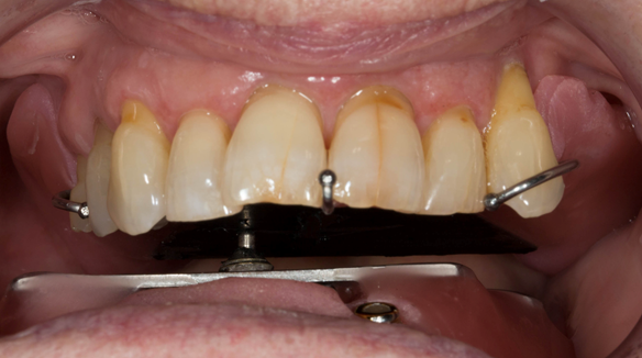 Figure 21 Registration visit with central bearing apparatus (gothic arch tracing) for CR recording moving to the patient's right