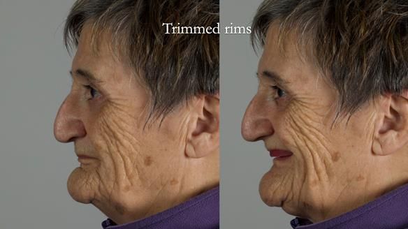 Newsletter 83: Sheila’s Complete Denture Success