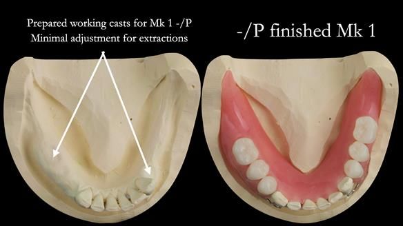Newsletter 52 Managing Jo’s failing dentition with extractions and Mk 1/Mk 2 complete upper dentures and lower partial dentures FULL PROTOCOL