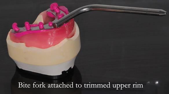 Newsletter 57 showcases the making and fitting process of implant-supported complete dentures for Alisdair