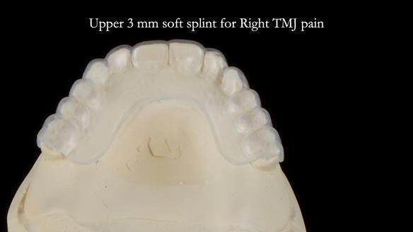 Newsletter 82 Mary - A complete upper and a one-tooth gasket denture