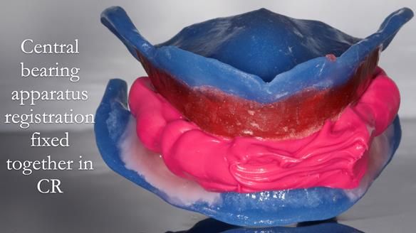 Newsletter 80 - Gordon’s dentures: the one case in 1,000 where my technique failed