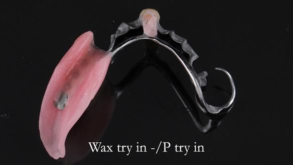 Newsletter 54 case presentation upper complete denture and lower Scandinavian designed hygienic partial denture for David