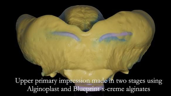 Newsletter 53 showing the making and fitting of ultra life-like dentures for Valena