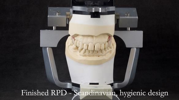 Newsletter 44 - extreme removable prosthodontics – engineering a super-strong and ultra-thin over denture