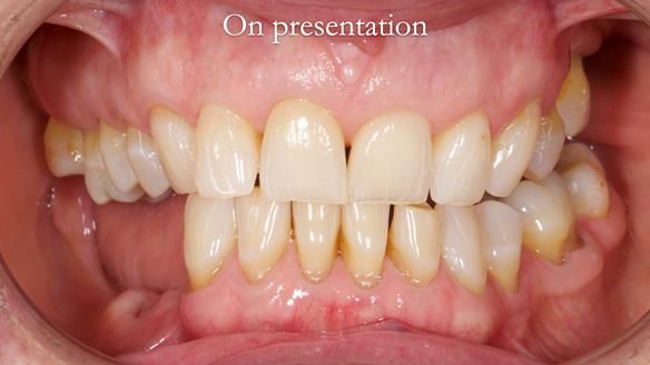 Finlay's Newsletter 61 provision of a lower unilateral free end saddle metal based partial denture for Joyce