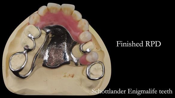 Eileen's transformation with upper and lower RPDs of Scandinavian hygienic design FULL PROTOCOL
