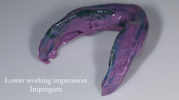 Replacing Madeline’s Complete denture FULL PROTOCOL