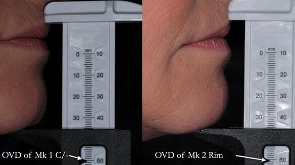 Newsletter 52 Managing Jo’s failing dentition with extractions and Mk 1/Mk 2 complete upper dentures and lower partial dentures FULL PROTOCOL