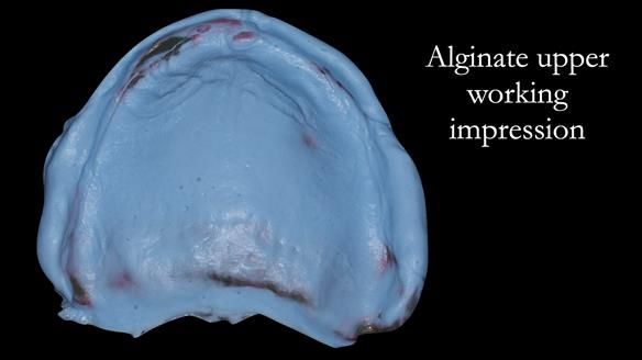 Managing poor implant positioning with complete dentures and Locator attachments - full protocol Newsletter 41