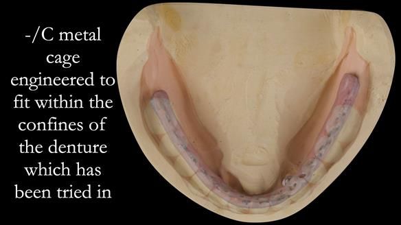 Managing poor implant positioning with complete dentures and Locator attachments - full protocol Newsletter 41