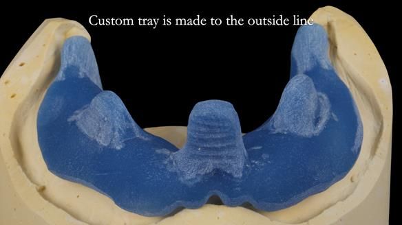 Newsletter 53 showing the making and fitting of ultra life-like dentures for Valena