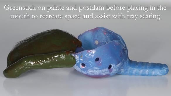 Newsletter 56 showing the making and fitting of a bilateral free end saddle upper removable partial denture (RPD) for patient with pemphigus