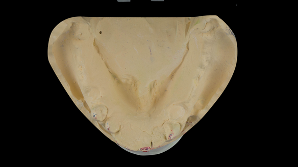 Figure 34 Prepared primary mandibular cast. Minimal preparation of the cast apart from careful removal of the teeth to be extracted owing to gross periodontal attachment destruction and alveolar bone loss