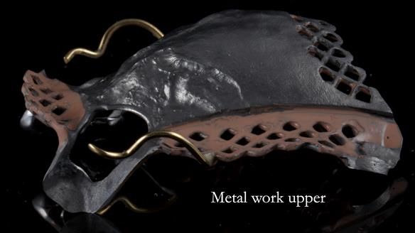 Finlay's Newsletter 59 Ultra hard partial dentures made for Gill