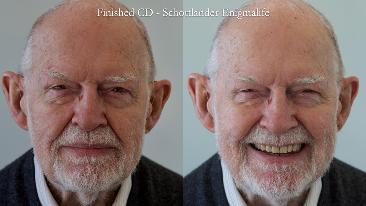 Newsletter 87 – Father Peter: A Partial Denture that needed Minor Miracle