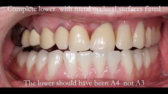 Newsletter 44 - extreme removable prosthodontics – engineering a super-strong and ultra-thin over denture