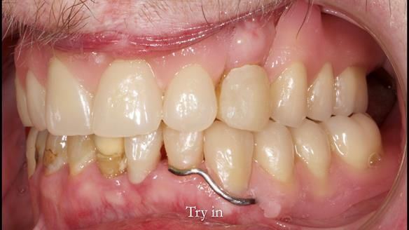 Newsletter 55 Provision of metal based partial dentures for Zephyrine with a repaired cleft lip and palate