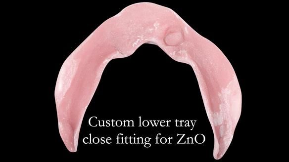 Managing poor implant positioning with complete dentures and Locator attachments - full protocol Newsletter 41