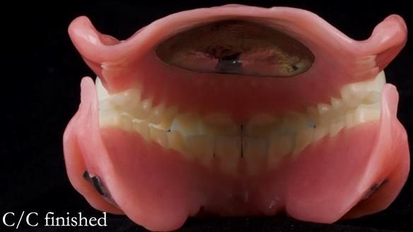 Managing poor implant positioning with complete dentures and Locator attachments - full protocol Newsletter 41