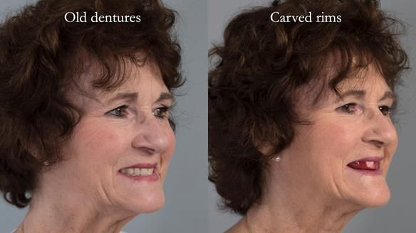 Newsletter 75: Marion’s case - Step-by-step complete denture workflow