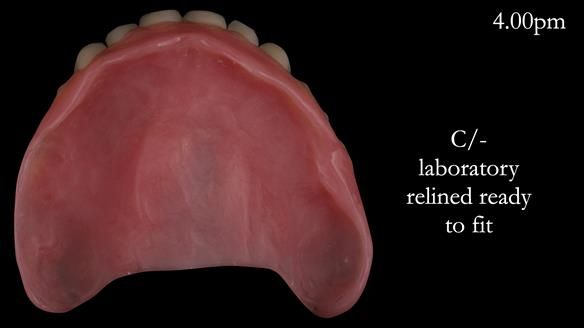 Newsletter 52 Managing Jo’s failing dentition with extractions and Mk 1/Mk 2 complete upper dentures and lower partial dentures FULL PROTOCOL