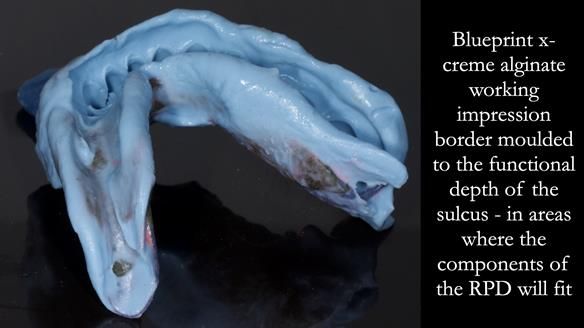 Finlay's Newsletter 61 provision of a lower unilateral free end saddle metal based partial denture for Joyce