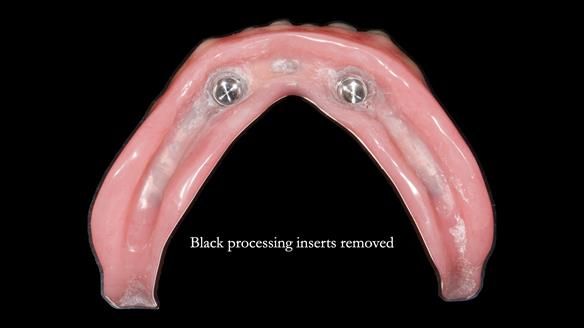 Newsletter 78: What do Clark Gable and a Locator® overdenture have in common?