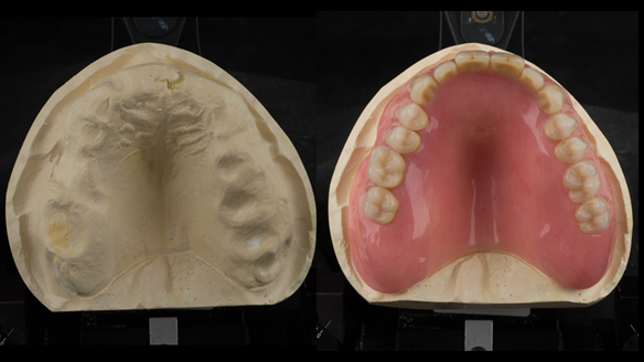 Figure 32 Prepared maxillary cast and the finished Mk 1 complete acrylic denture