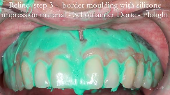 Newsletter 54 case presentation upper complete denture and lower Scandinavian designed hygienic partial denture for David