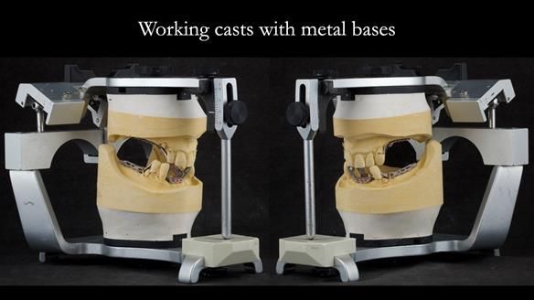 Finlay's Case Study Newsletter 40 - Immediate Mk 1 RPD to Definitive Mk 2 RPD - full protocol