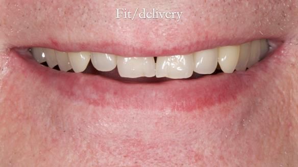 Newsletter 57 showcases the making and fitting process of implant-supported complete dentures for Alisdair