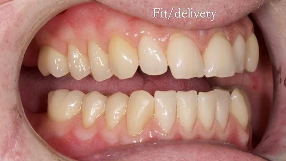 Newsletter 57 showcases the making and fitting process of implant-supported complete dentures for Alisdair