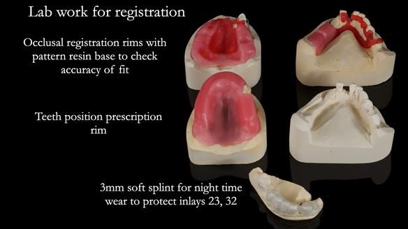 Newsletter 55 Provision of metal based partial dentures for Zephyrine with a repaired cleft lip and palate